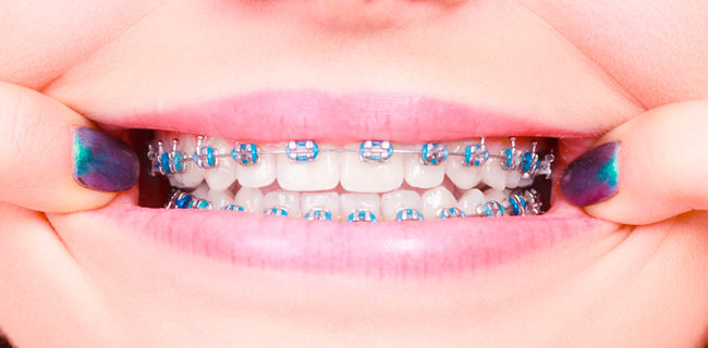 Ortodoncias fijas Morales Cervera