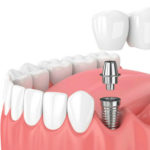 implantes dentales Palencia Morales Cervera