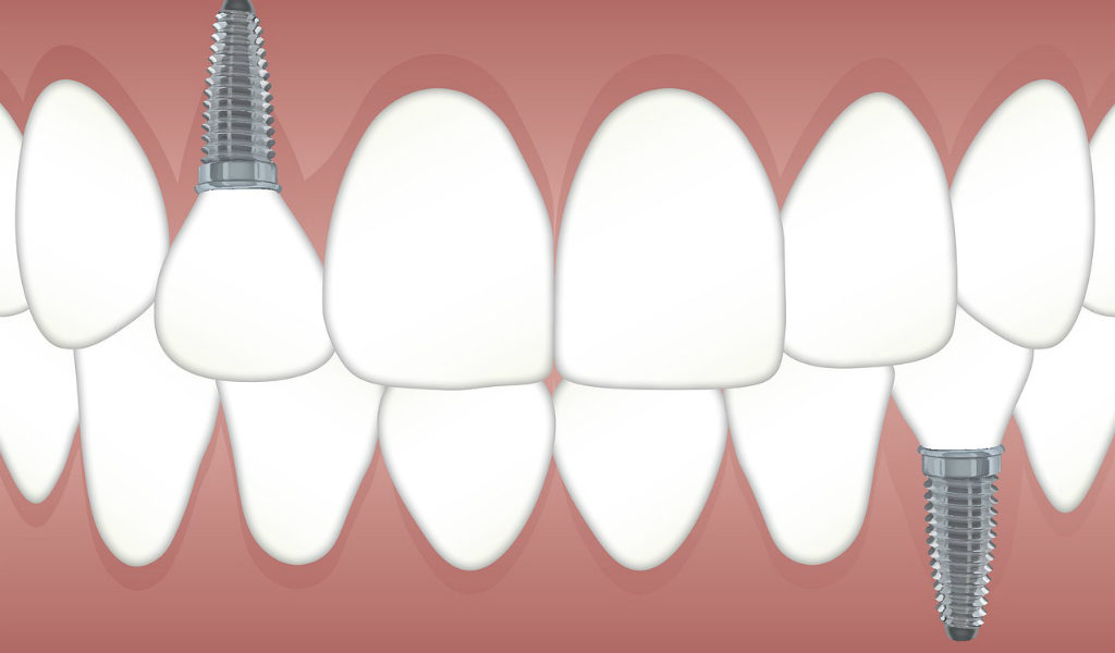 implantes dentales de calidad morales cervera