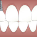 implantes dentales de calidad morales cervera