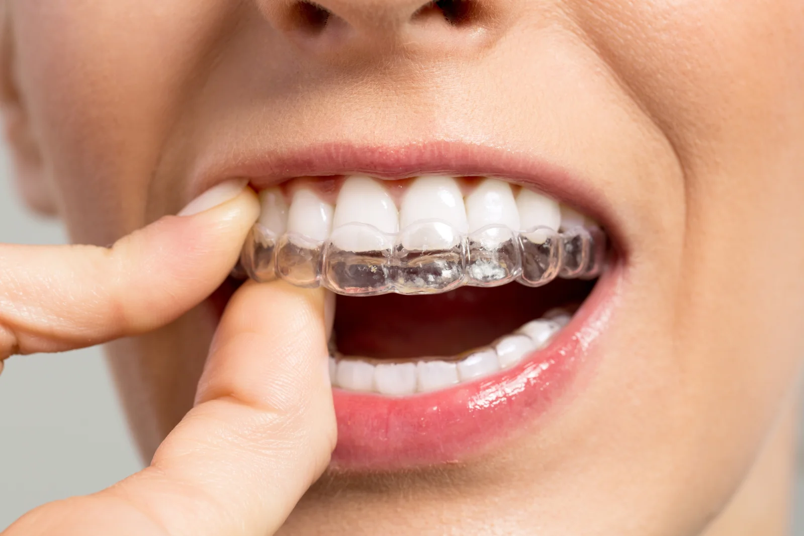 Qué es la ortodoncia invisible Invisalign? - Morales Cervera