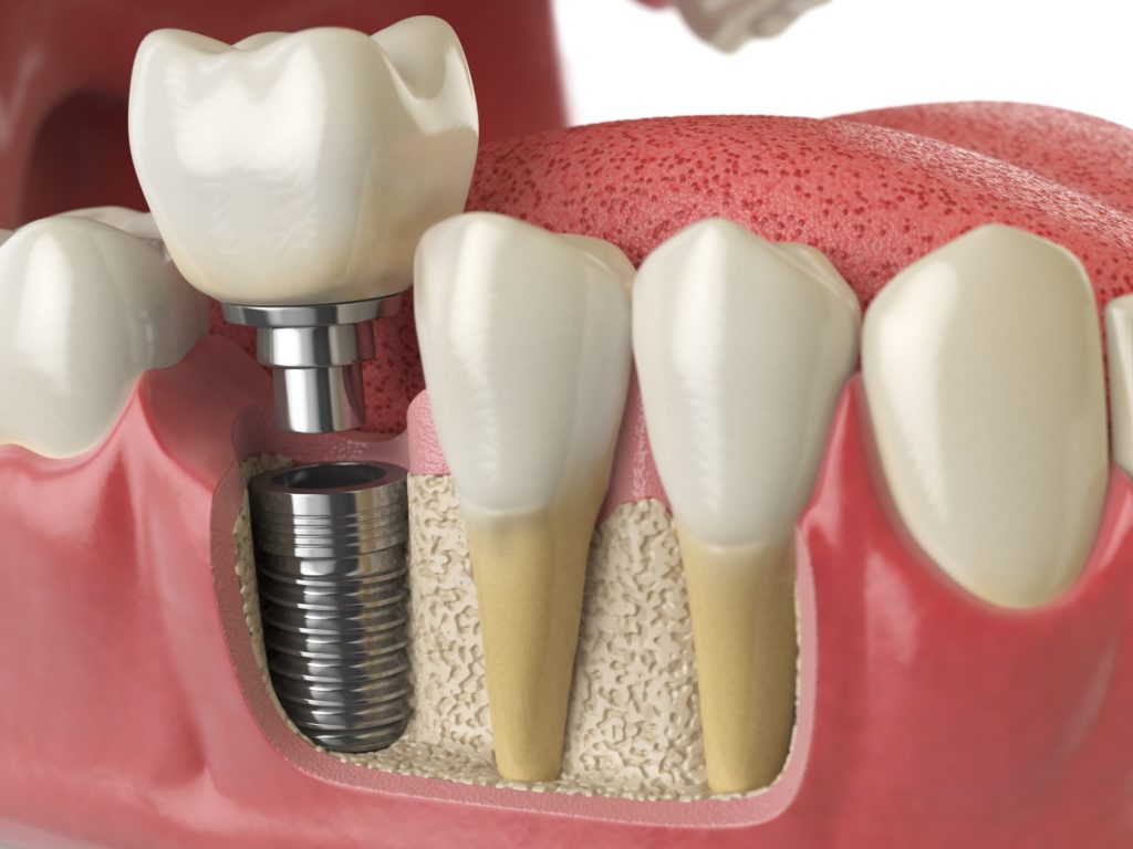 Cuidados debes seguir implante dental