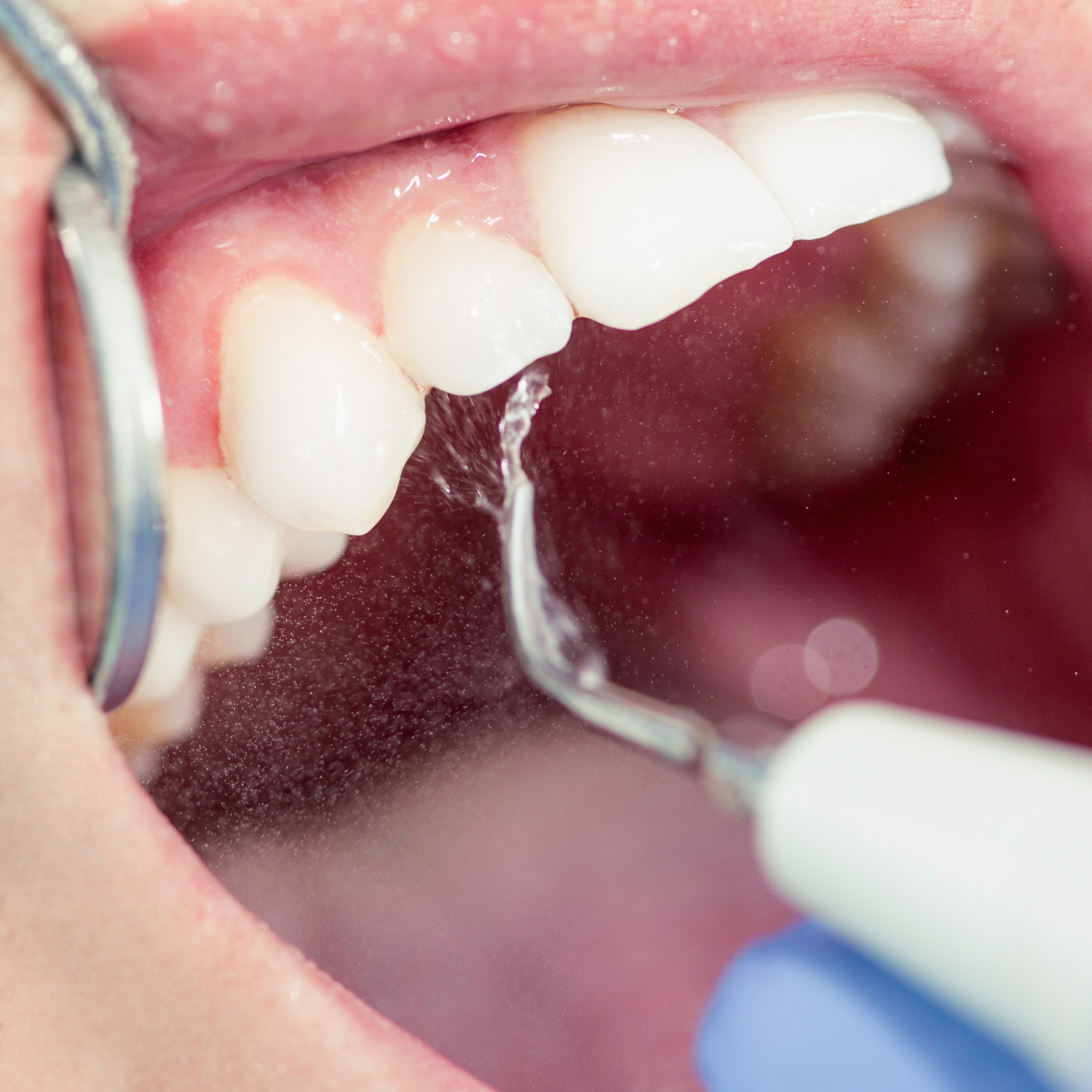 como afecta la placa bacteriana a tus dientes morales cervera