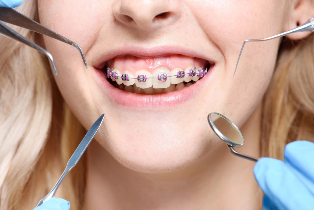 Consejos para cuidar tu ortodoncia