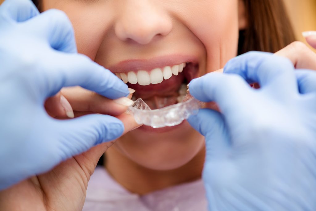 Consejos para cuidar tu ortodoncia dental invisible