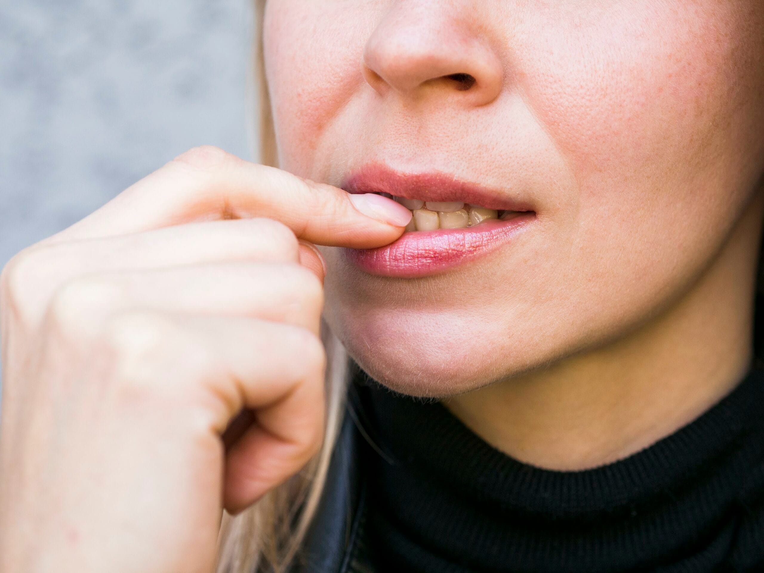 Mujer señalando su mordida cruzada que muestra los dientes desalineados, ilustrando un caso común de maloclusión dental.