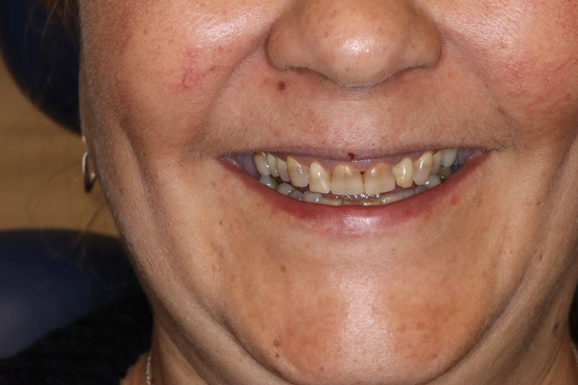 Paciente antes del tratamiento dental en Morales Cervera