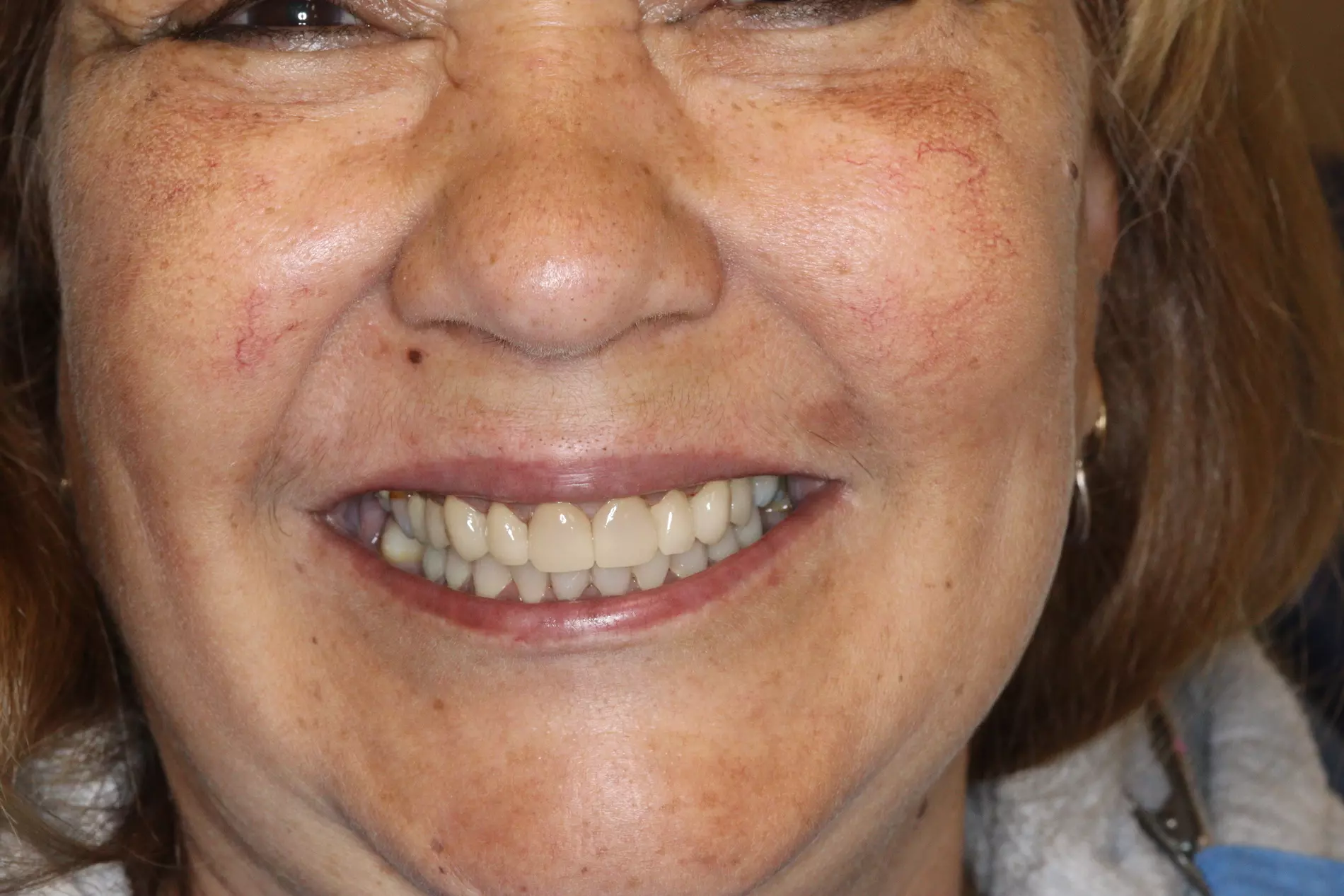 Paciente después del tratamiento dental en Morales Cervera